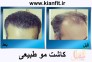 مرکز کاشت مو و زیبایی کیان فیت