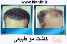 مرکز کاشت مو و زیبایی کیان فیت
